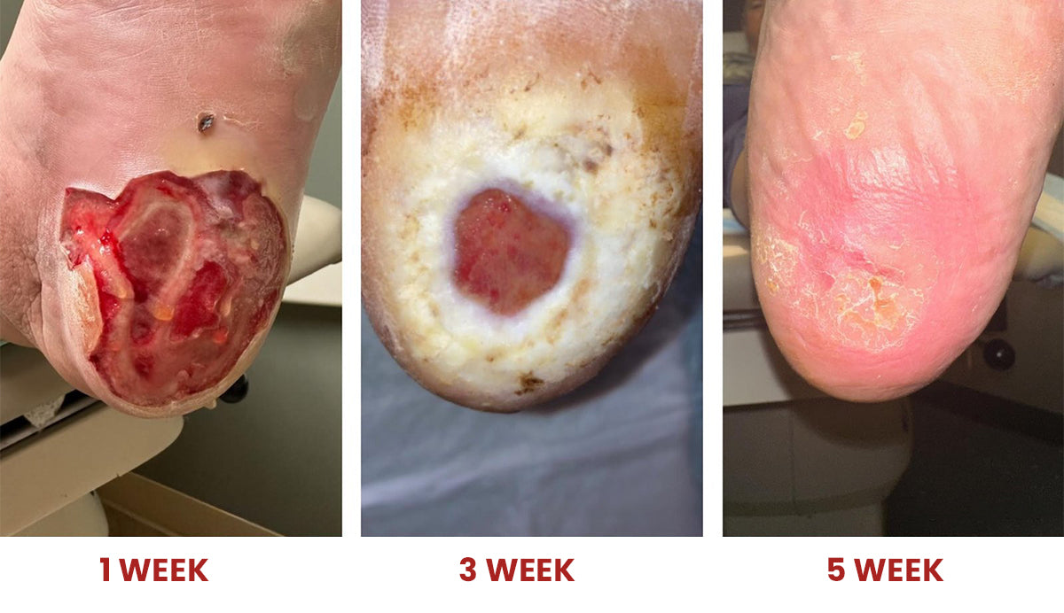 Cvreoz® Advanced Wound Healing Cream for Diabetic Skin 21 Image 20 1 fcc346a3 d9b6 4d3f ad3d 1d07c660dd44